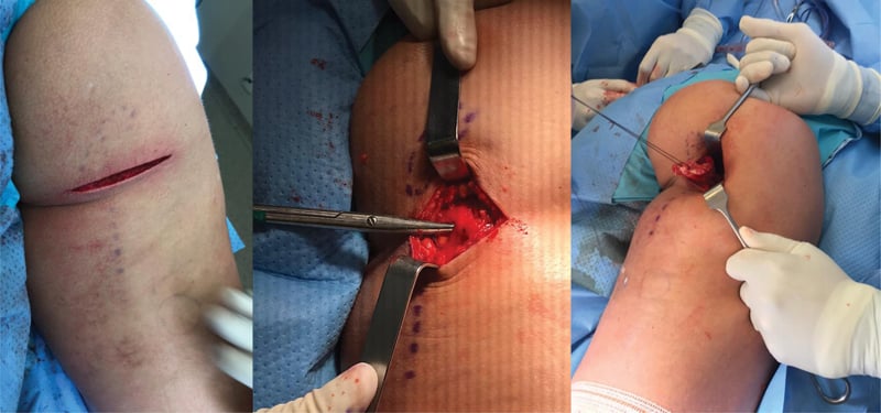 Operative sequence exposing proximal hamstring stump and posterior femoral cutaneous nerve