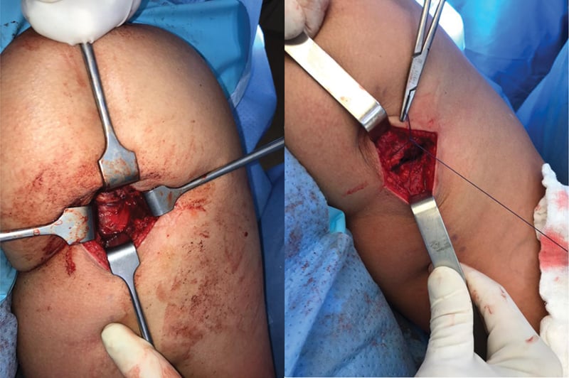 Reinserted proximal hamstring tendon and fascial closure after anchor repair