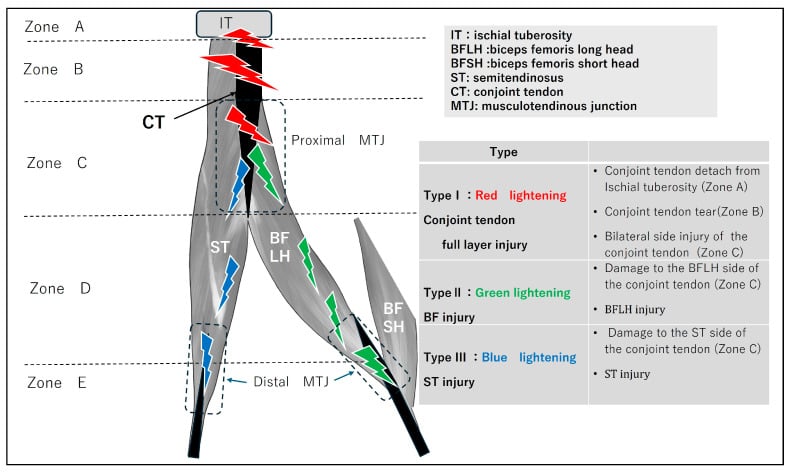 Anatomical zone map for localising biceps femoris and semitendinosus complex injuries on MRI