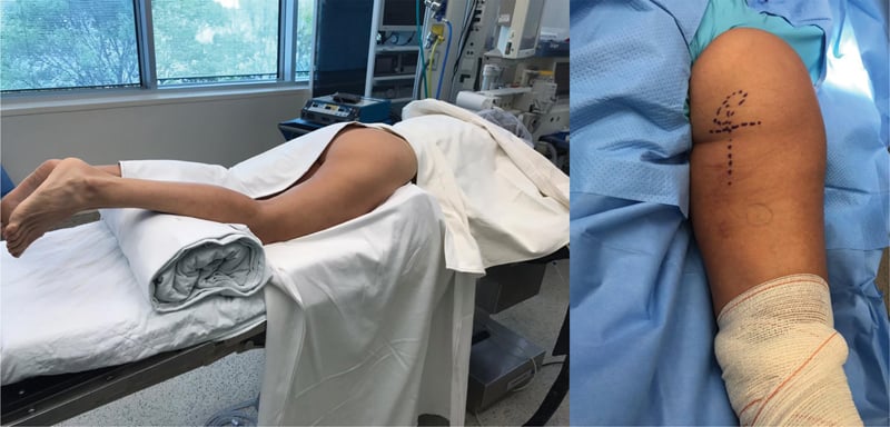Prone positioning and incision planning for proximal hamstring repair