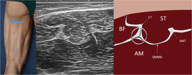Short-axis ultrasound and schematic of proximal hamstring compartments around the sciatic nerve