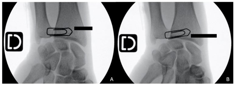 Standardized PA radiograph of the hand and wrist demonstrating joint articulations