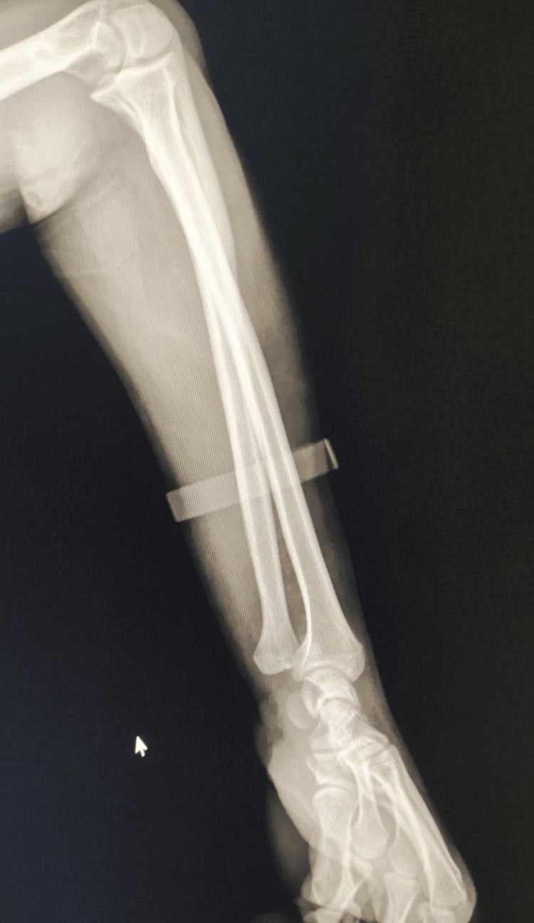 PA and lateral radiographs of wrist demonstrating joint alignment