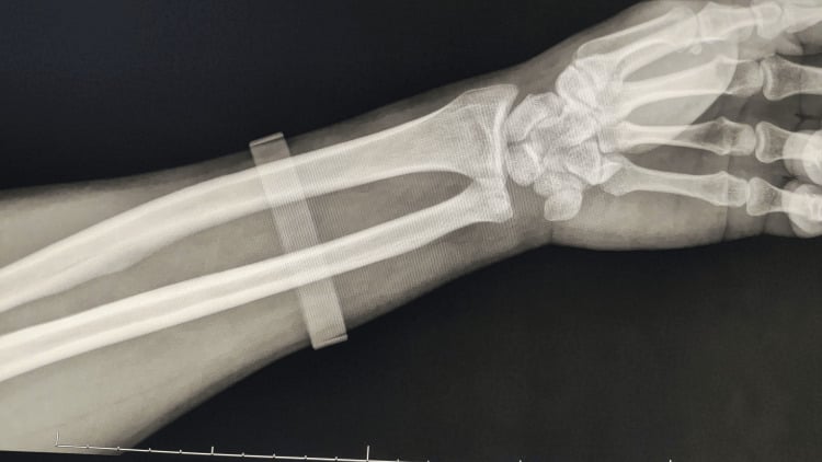 Axial CT of wrist demonstrating DRUJ congruity