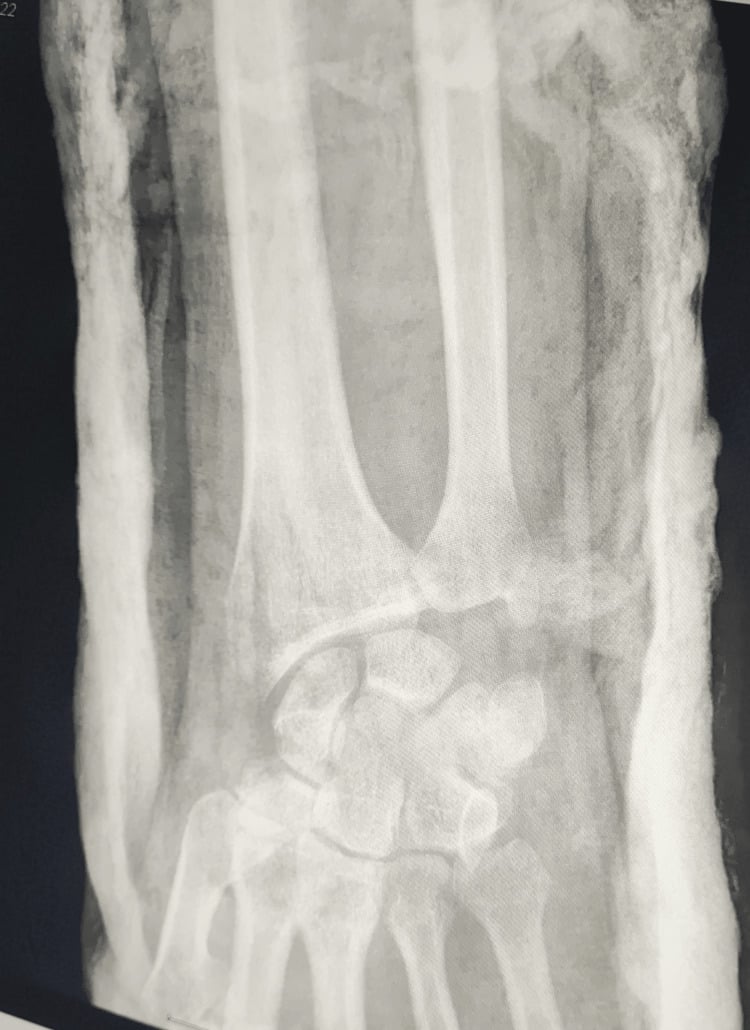 Postoperative PA radiograph of wrist showing joint reduction
