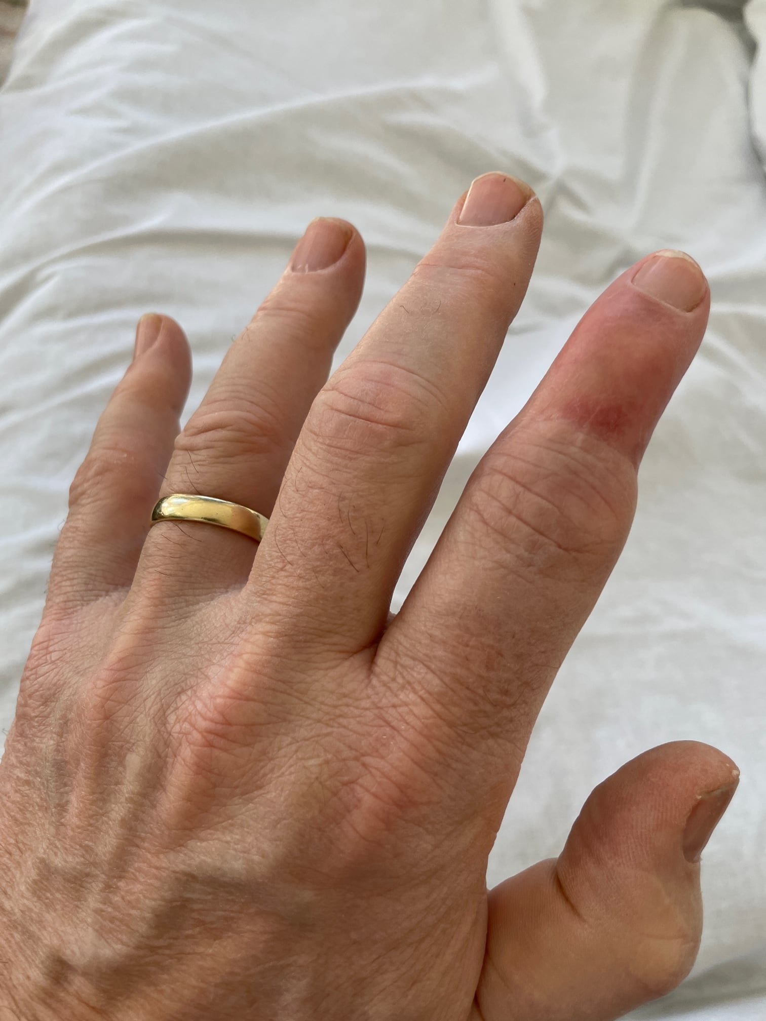 Clinical photograph of an index finger one year after replantation, showing a viable healed digit with residual colour change at the tip.