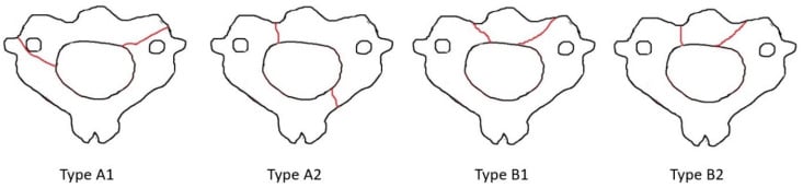 Axial Li-Wang classification diagrams of atypical Hangman's fracture lines