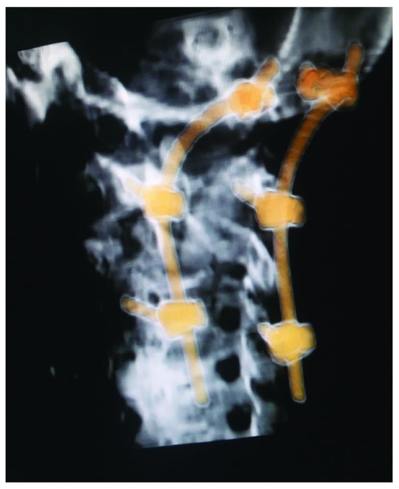 Three-dimensional CT reconstruction of a posterior C1-C3 fixation construct for an unstable Hangman's fracture
