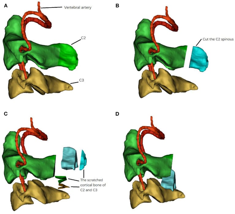 Four-step diagram of posterior C2-C3 exposure, decortication and vascularised spinous muscle complex grafting