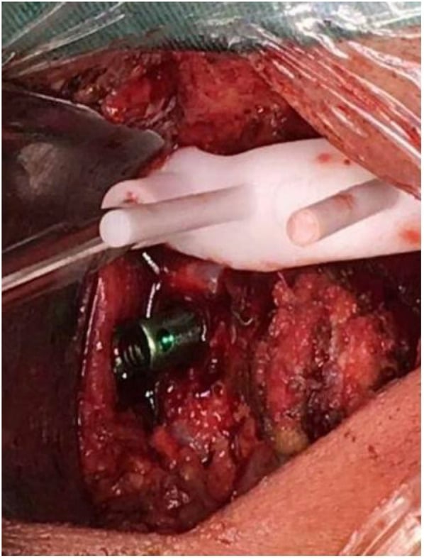 Intraoperative patient-specific guide used for navigated C2 pedicle screw placement
