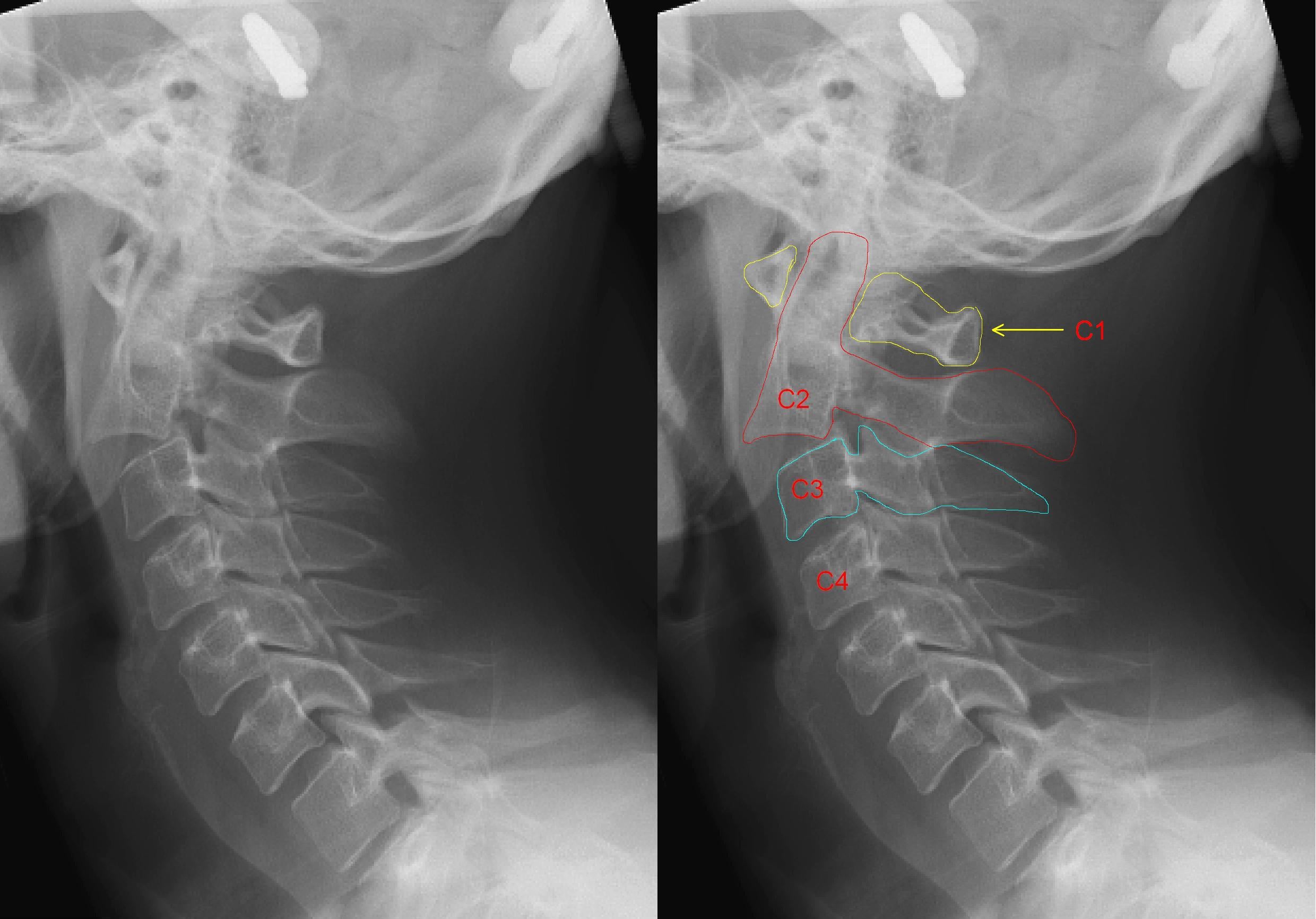 Lateral cervical radiograph showing Hangman's fracture with C2 anterior translation on C3