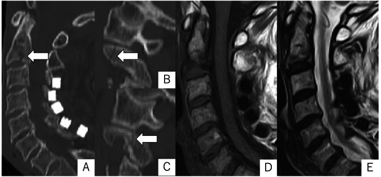 Multiplanar CT and sagittal MRI of a complex C2 body and pedicle fracture