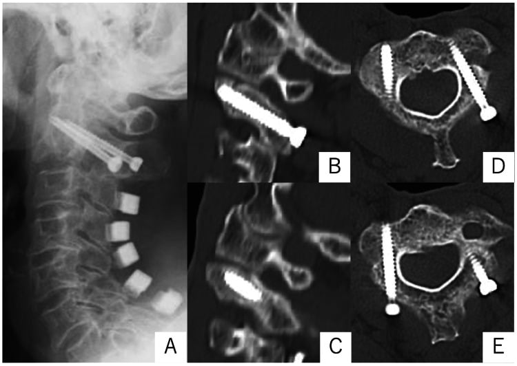 Postoperative radiograph and multiplanar CT after direct bilateral C2 screw osteosynthesis