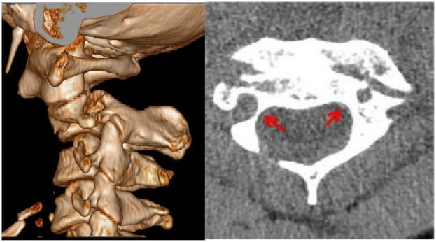 Three-dimensional and axial CT of a Hangman's fracture with a high-riding vertebral artery