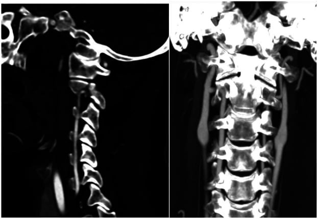 Sagittal and coronal CT angiography showing vertebral artery anatomy before C2 screw fixation