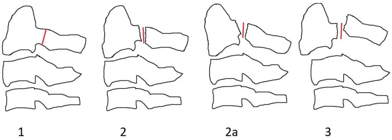 Levine-Edwards classification diagrams for Type I, II, IIA and III Hangman's fractures