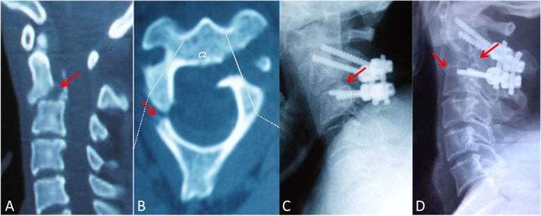 Levine-Edwards Type II Hangman's fracture CT and X-ray imaging