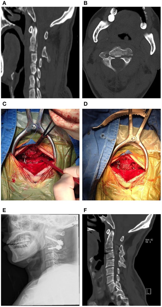 Preoperative CT, intraoperative exposure and postoperative radiographs of posterior C2-C3 fixation