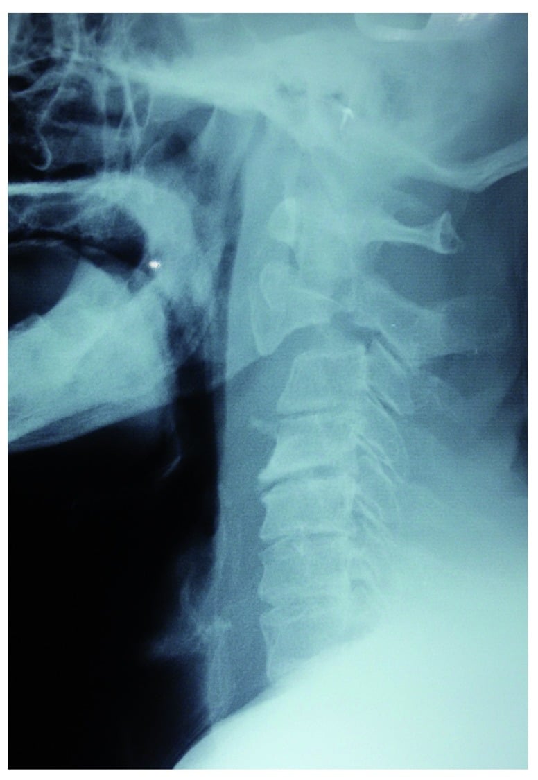 Management decision radiograph after traction reduction of a selected unstable Hangman's fracture
