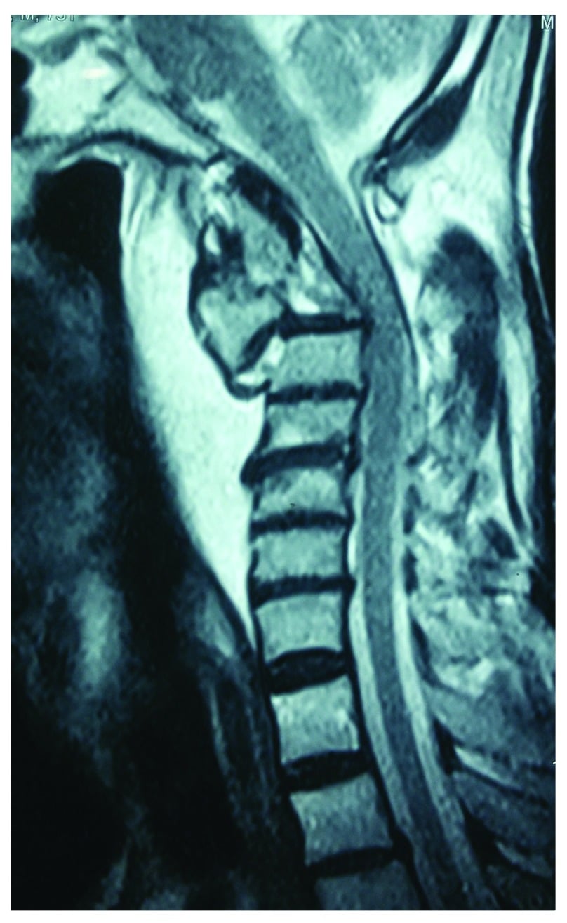 Sagittal T2 MRI of an unstable Hangman's fracture showing focal canal pinching without cord signal change