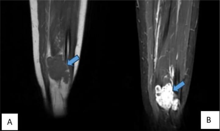 Coronal T1 and STIR MRI of an intramuscular haemangioma in flexor hallucis longus