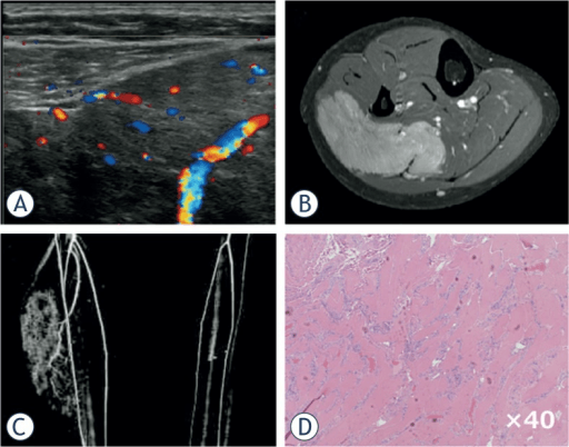 Intramuscular hemangioma of gastrocnemius with multimodal imaging