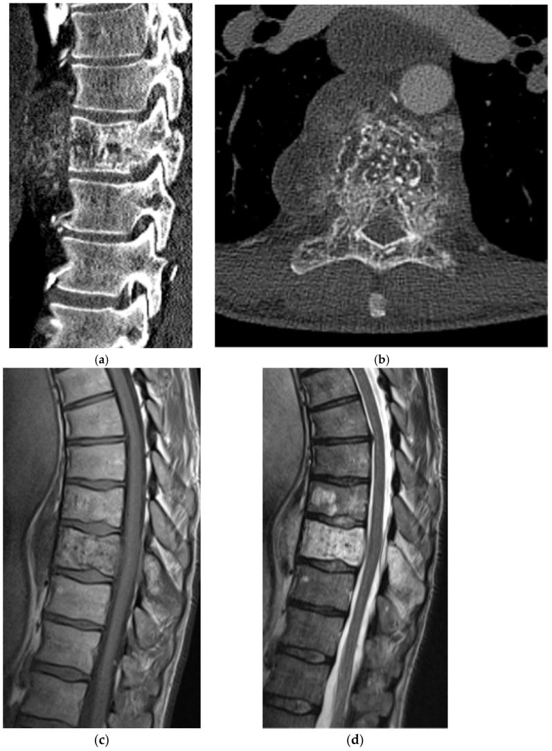 CT and MRI of aggressive vertebral haemangioma with osseous expansion and canal compromise
