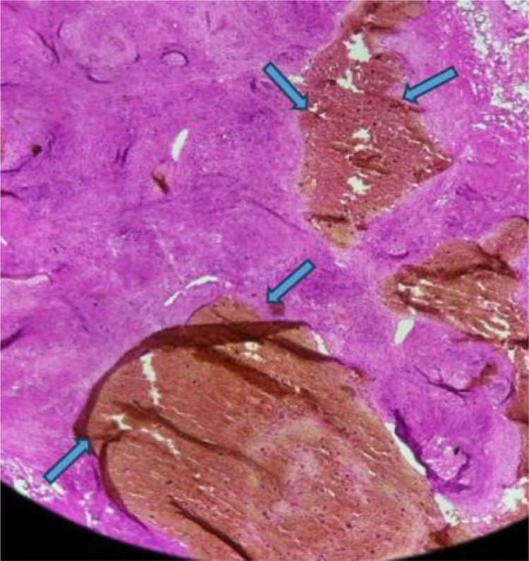 Histology of intramuscular haemangioma with dilated thin-walled vessels