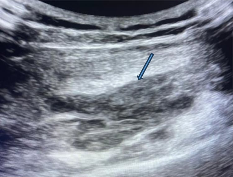 Ultrasound of an intramuscular haemangioma with a lobulated hypoechoic mass