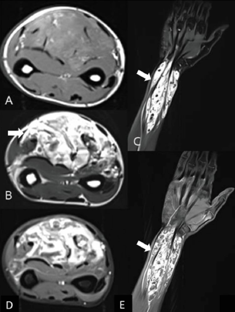 MRI of a slow-flow venous malformation involving forearm tissue planes