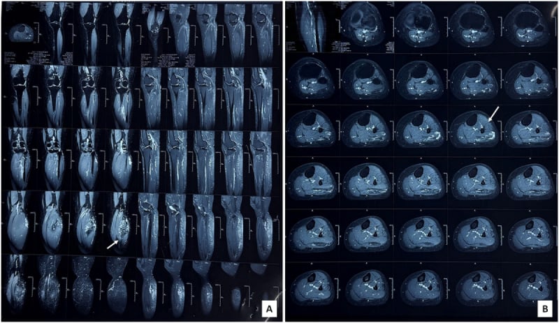 MRI of intramuscular haemangioma in lateral gastrocnemius with draining vessels