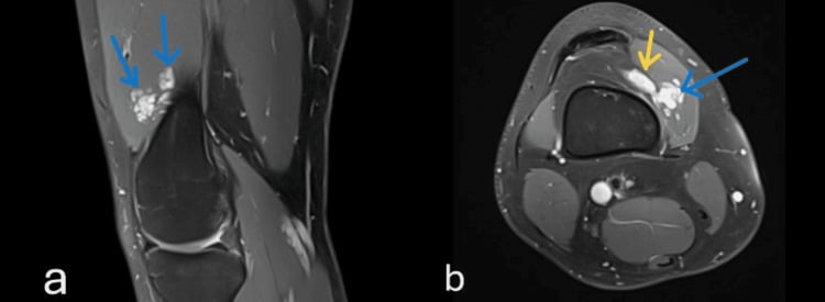 Sagittal and axial MRI of combined intramuscular and synovial knee haemangioma