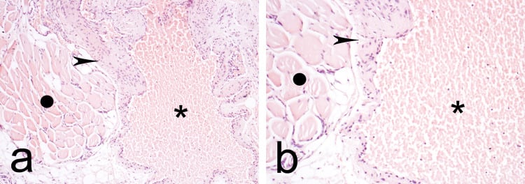 Low- and high-power histology of cavernous intramuscular haemangioma