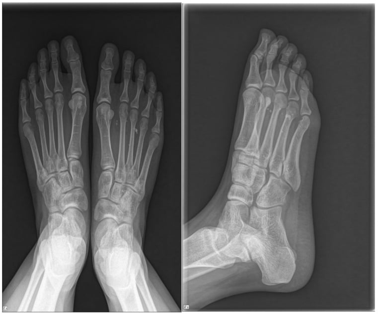Foot radiographs showing multiple phleboliths in a vascular lesion