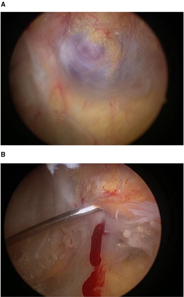 Arthroscopic view and puncture of a posterior knee synovial haemangioma