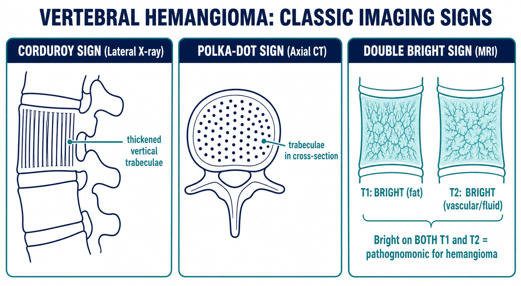 Schematic diagram of the three classic vertebral hemangioma imaging signs: corduroy sign on lateral X-ray, polka-dot sign on axial CT, and double bright sign on MRI