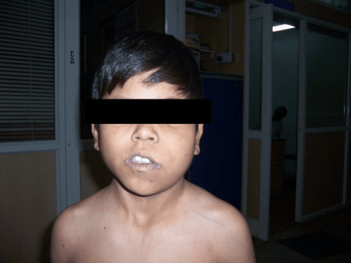 Frontal clinical photograph of an adolescent boy with one-sided body overgrowth and asymmetry of the two body halves