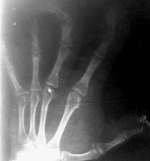 Anteroposterior radiograph of a hand showing disproportionately enlarged and broadened phalanges of the radial-sided digits