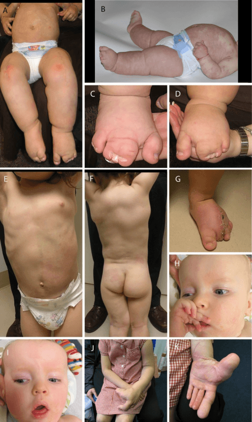 Multi-panel clinical montage of infants and children with asymmetric segmental overgrowth of a limb, buttock and hand