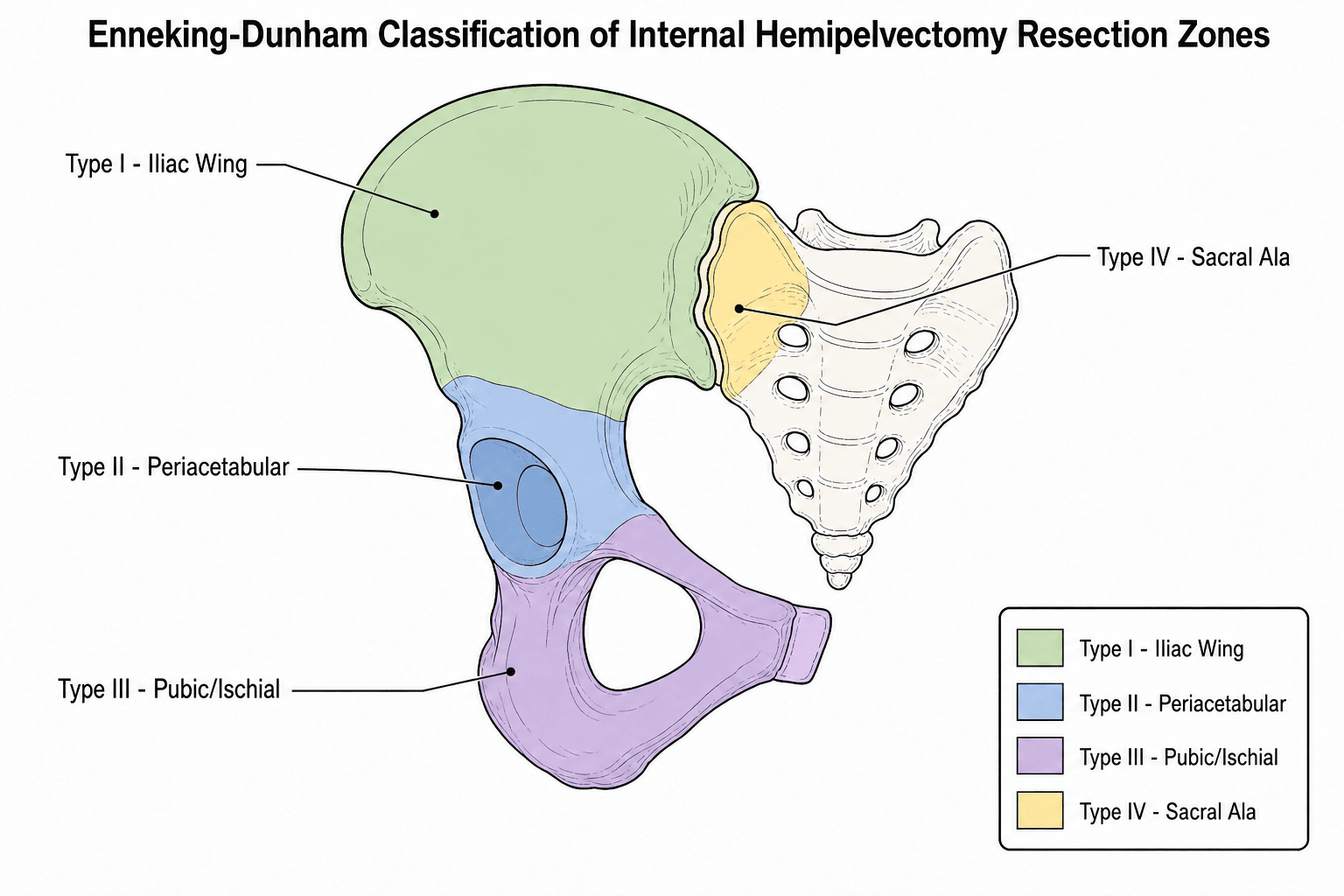 Enneking-Dunham classification of internal hemipelvectomy resection zones showing Type I iliac wing, Type II periacetabular, Type III pubic/ischial and Type IV sacral ala zones on a hemipelvis and sacrum.