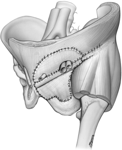 Anatomical illustration of synthetic mesh reconstruction of a pelvic bony defect after internal hemipelvectomy, with the femoral head suspended below the mesh.