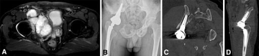 Four-panel LUMiC endoprosthesis case example: preoperative axial MRI of an acetabular chondrosarcoma, postoperative AP radiograph, and postoperative coronal and sagittal CT showing the endoprosthetic stem.