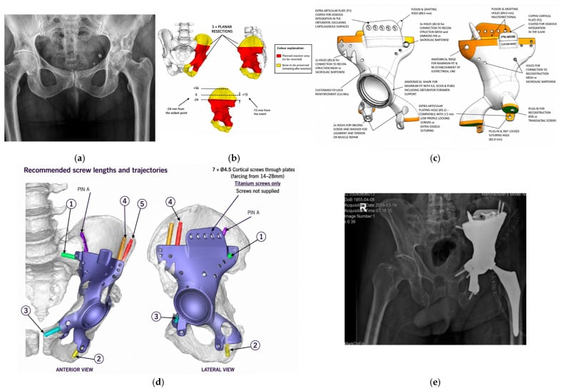 Five panels, a to e: preoperative radiograph, three planar resections with resected and preserved bone coloured, annotated implant design, recommended screw lengths and trajectories, and postoperative radiograph of a custom three-dimensional hemipelvic prosthesis