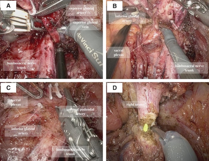 Four operative views, A to D, labelling the superior gluteal artery and vein, inferior gluteal and internal pudendal arteries, lumbosacral nerve trunk, sacral plexus and right ureter