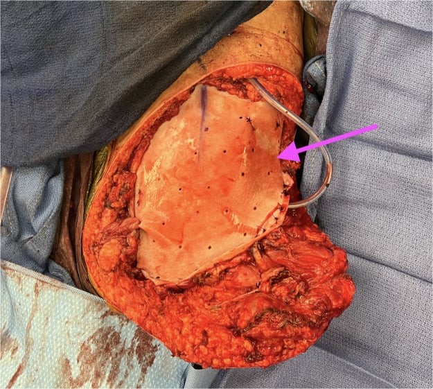 Operative view after external hemipelvectomy of a sheet of biologic mesh, marked by an arrow, sutured across the defect with a drain in place