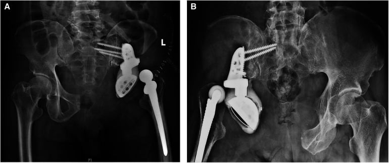 Two pelvic radiographs showing dislocation after prosthetic hemipelvic reconstruction