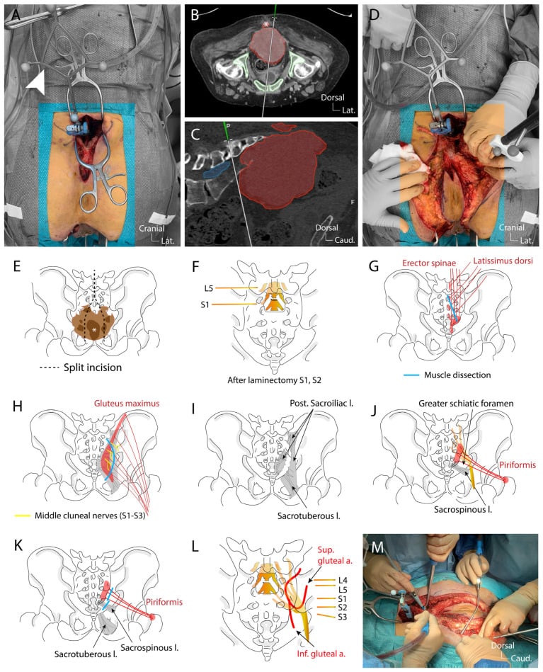 Operative photographs and diagrams showing navigated posterior sacrectomy, laminectomy and sacral-root exposure