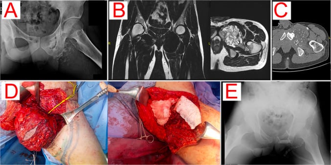Five panels, A to E: radiograph, coronal and axial MRI, axial CT, operative views and postoperative radiograph of an obturator-foramen chondrosarcoma resection and reconstruction