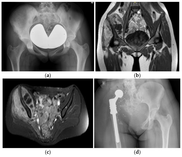 Four panels, a to d: AP pelvic radiograph, coronal and axial MRI of a right iliac osteosarcoma, and a postoperative radiograph of the right hemipelvic endoprosthetic reconstruction
