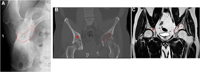 Pelvic radiograph, coronal CT and coronal MRI with a periacetabular chondrosarcoma outlined in red